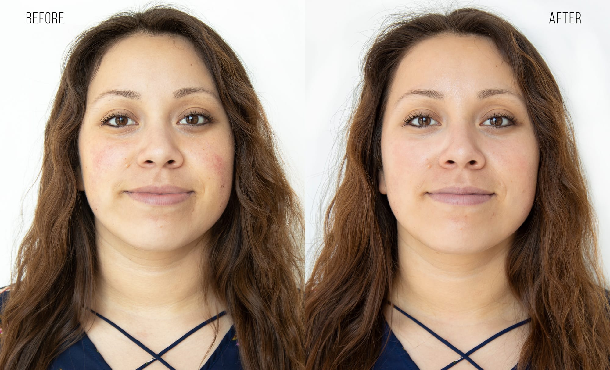 HydraFacial Before & After