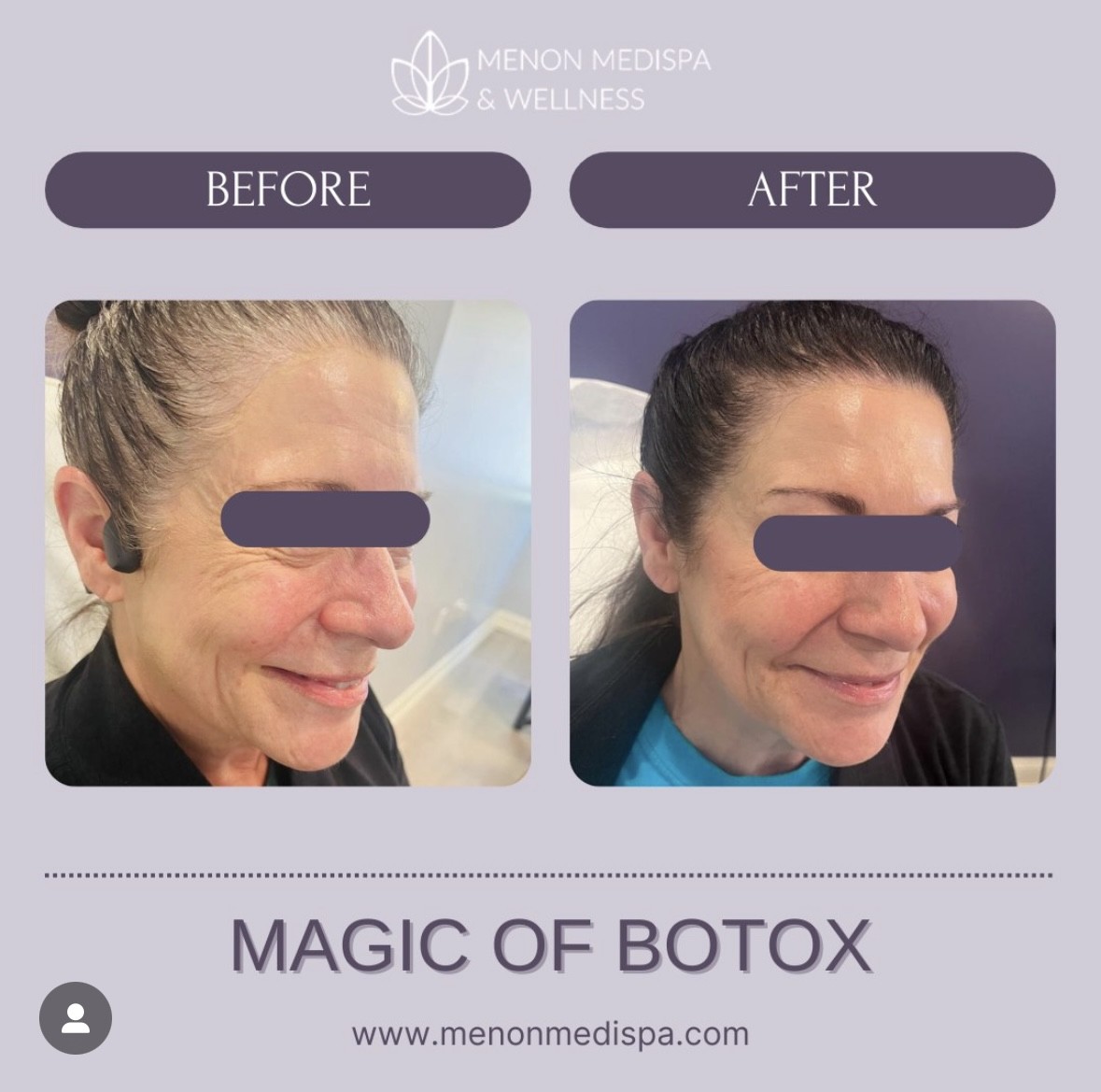 The magic of Botox: before and after results at Menon Medispa