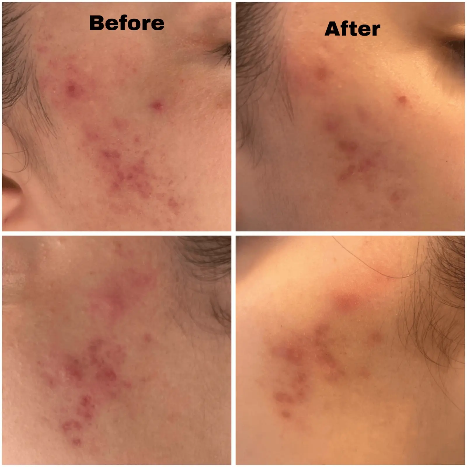 Before and after acne facial results at Menon Medispa Millburn NJ