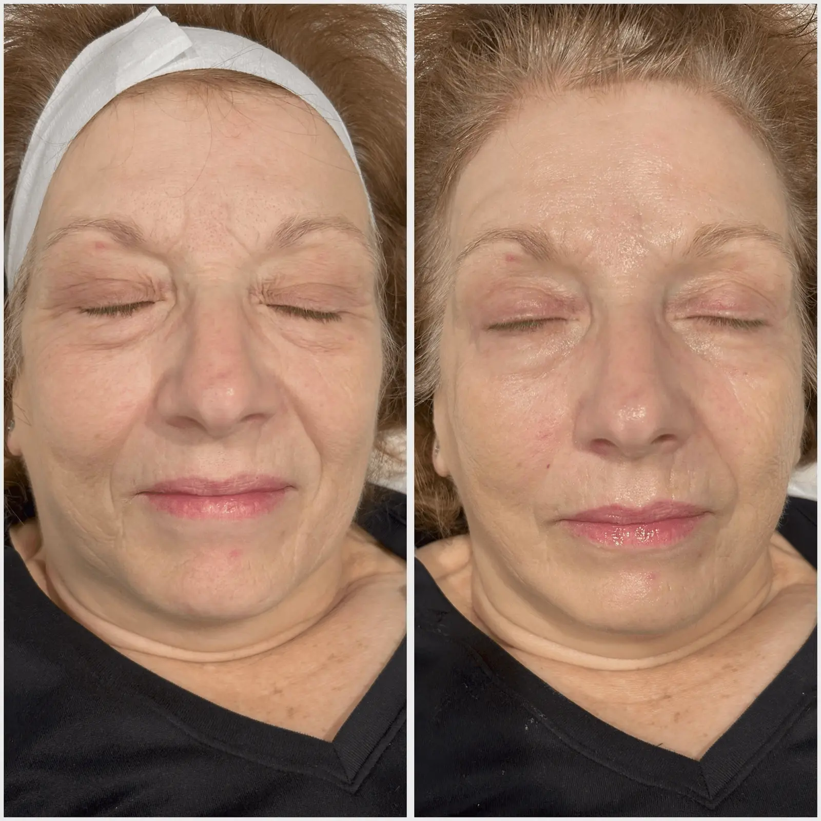 Before and after laser facial results, wrinkle reduction under eyes