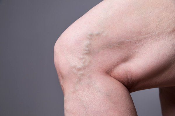 Vascular Treatments at Menon Medispa Millburn NJ