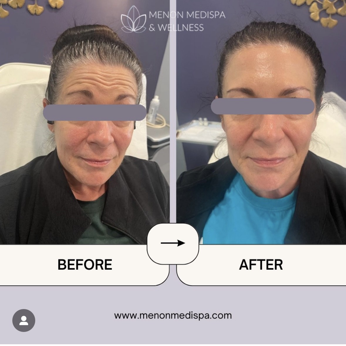 Botox before and after at Menon Medispa: refreshed, lifted appearance