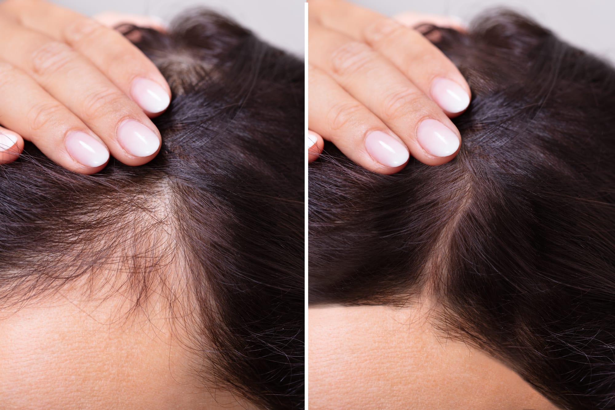 Before and after woman hair restoration results at Menon Medispa
