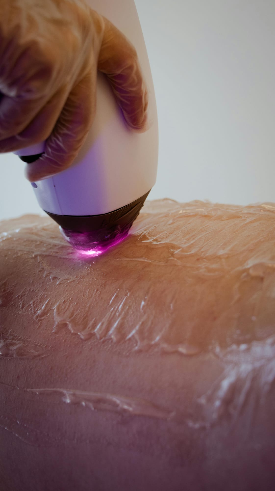 Targeted laser hair removal treatment session at Menon Medispa Millburn NJ