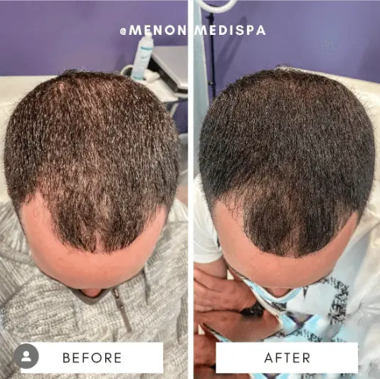 Before and after men hair restoration at Menon Medispa