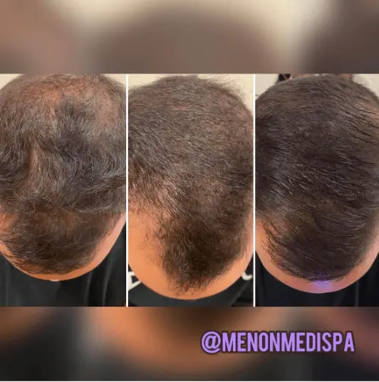 Before and after men hair restoration results at Menon Medispa