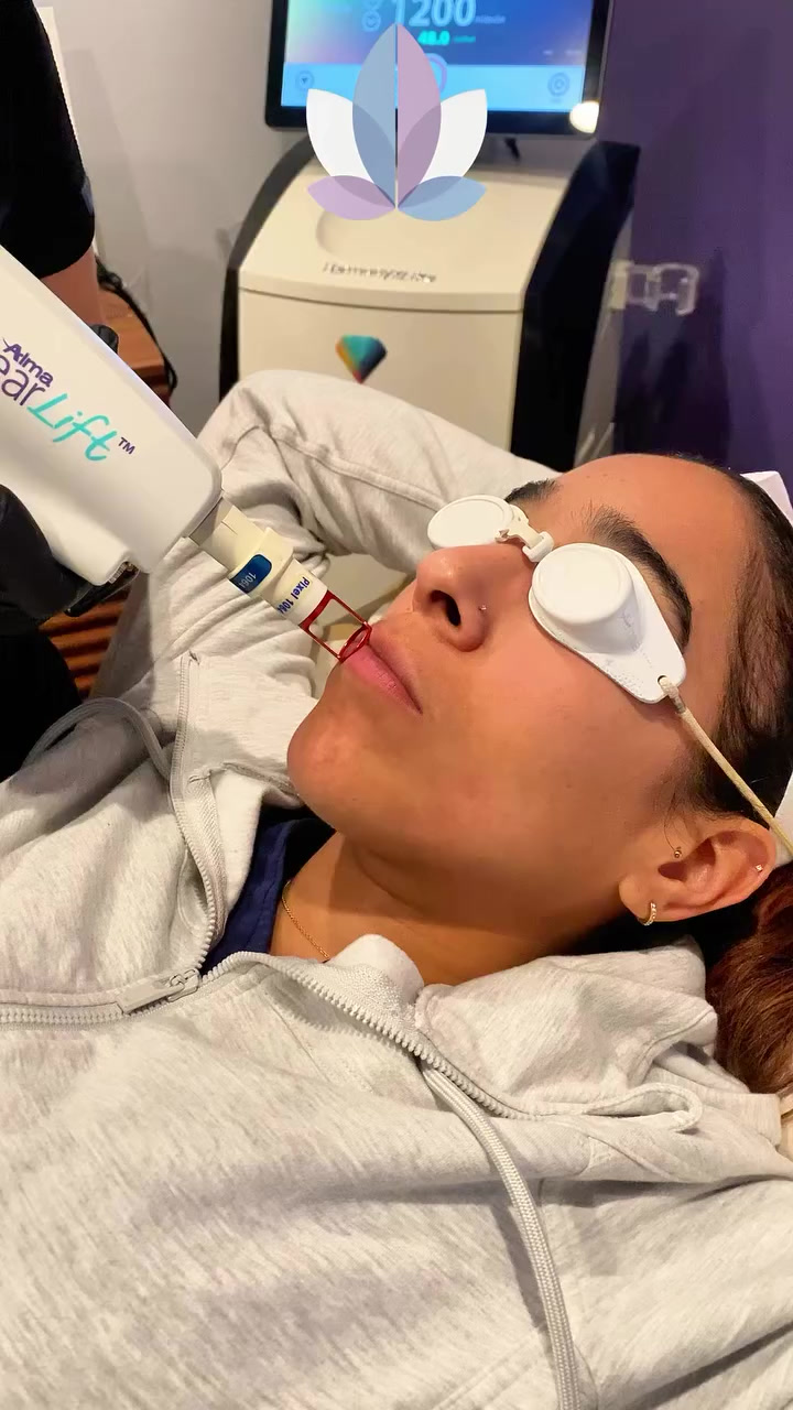 ClearLift laser lip enhancement treatment demonstration at Menon Medispa