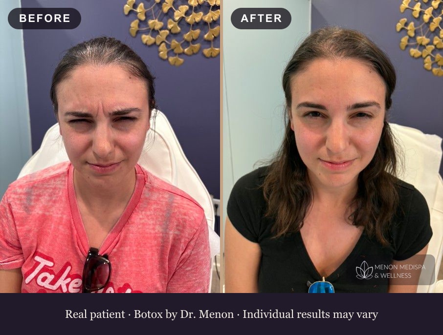 Botox before and after at Menon Medispa in Millburn, NJ: deep frown lines softened to a smooth, relaxed result