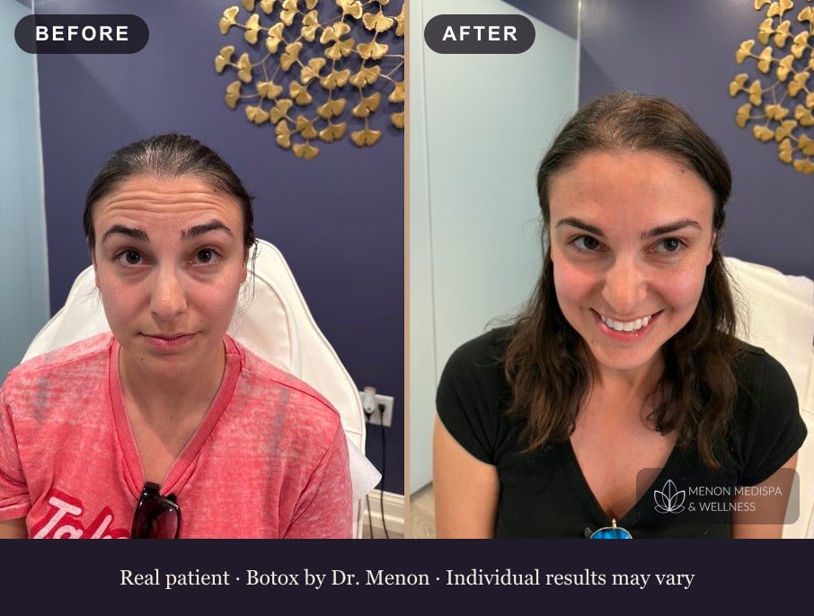 Botox before and after at Menon Medispa in Millburn, NJ: a refreshed, natural-looking result