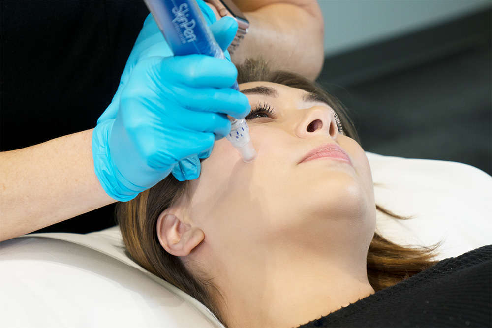 SkinPen microneedling treatment