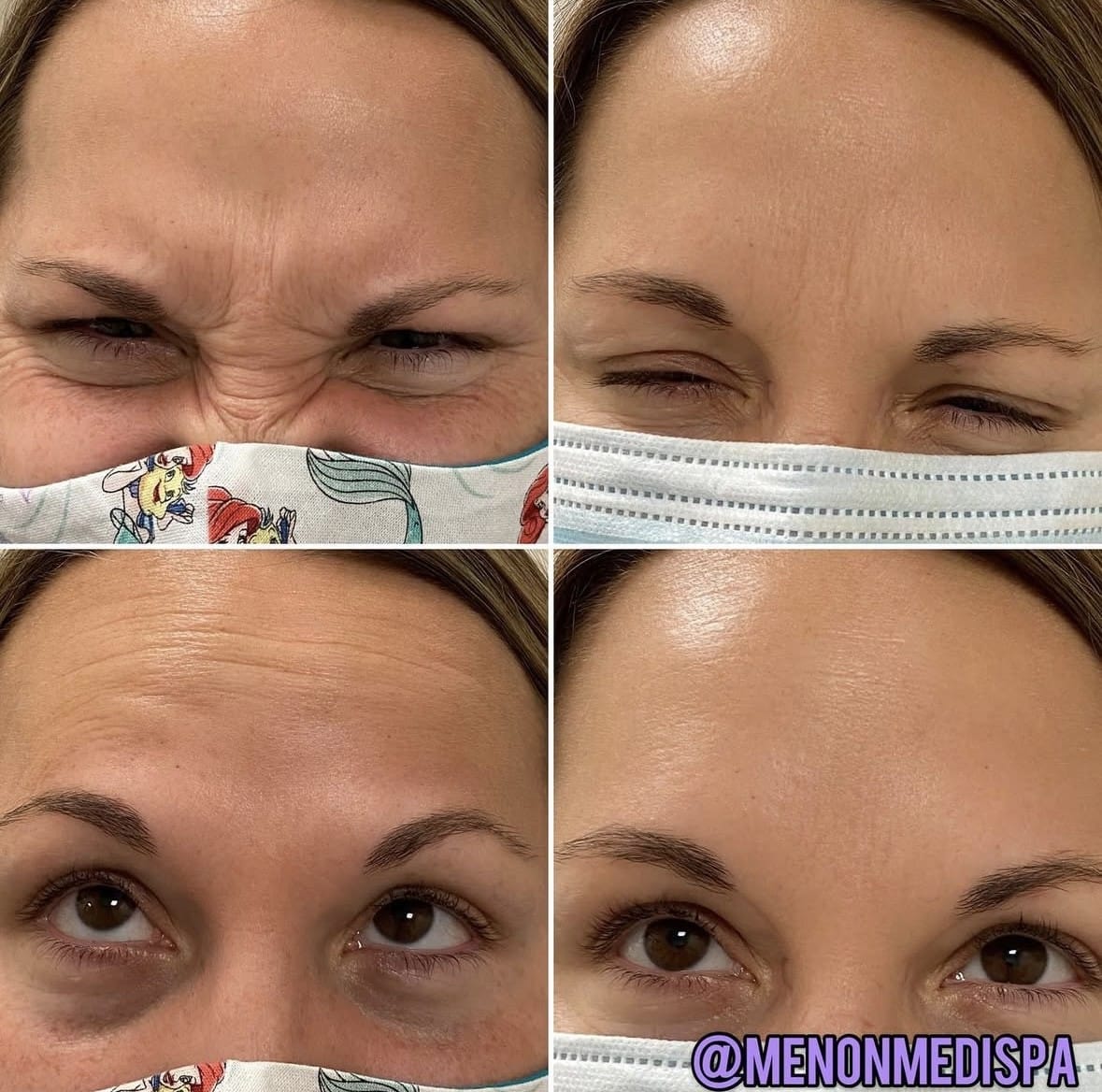 Botox before and after at Menon Medispa: forehead and under-eye lines smoothed
