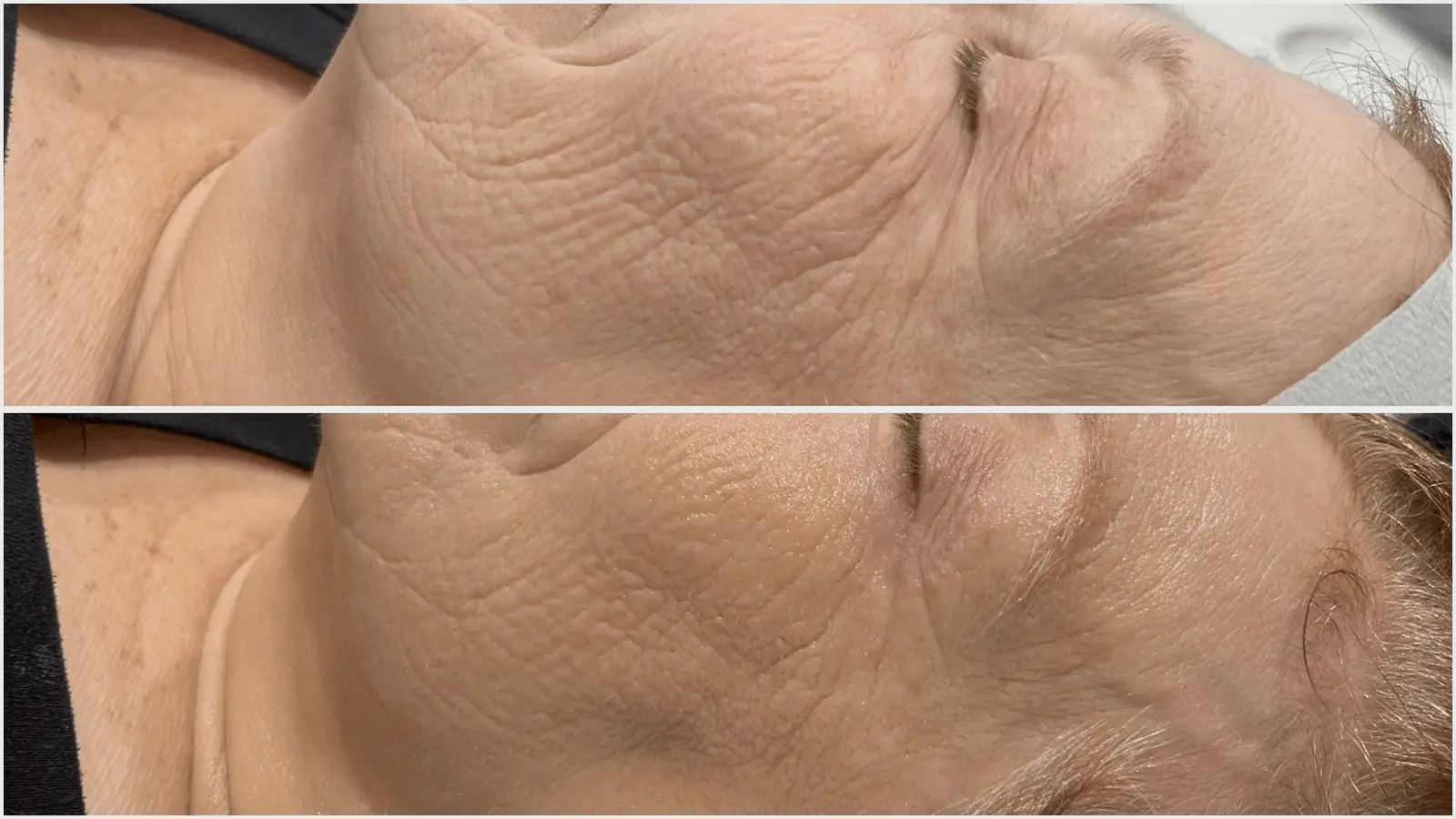 Before and after ClearLift laser facial comparison
