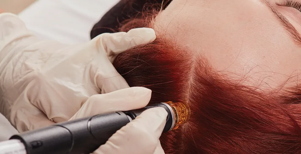 The Benefits of Hair Restoration Therapy