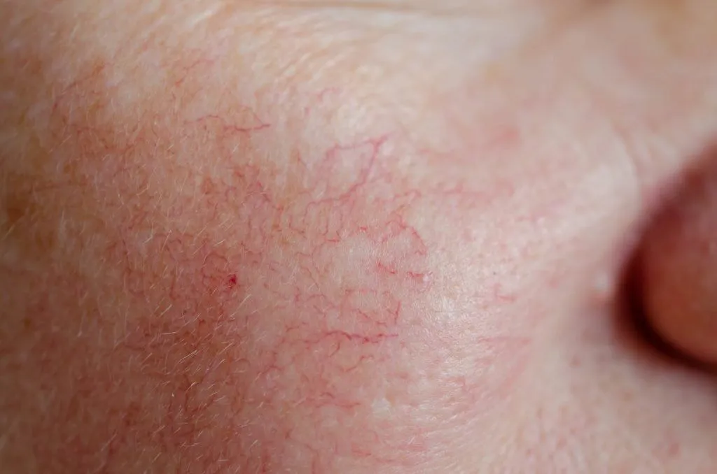 How to Get Rid of Spider Veins with Laser Treatment